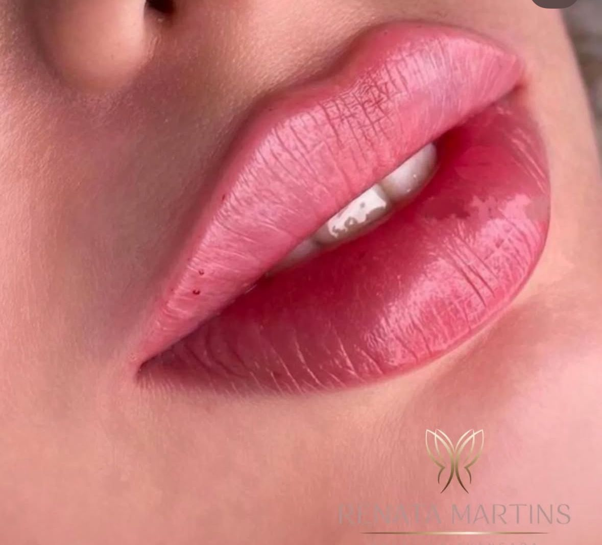 Antes e Depois - Harmonização Labial