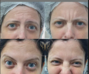 Antes e Depois - Tratamento Facial